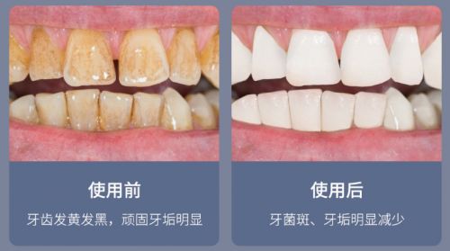 告別刷牙盲區，現代口腔護理新選擇 為何它能解決你的深層困擾